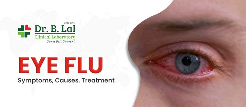 Eye Flu - Symptoms, Causes and Treatment